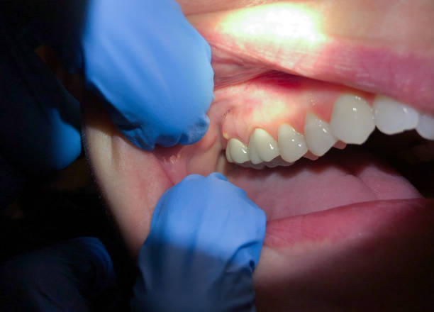 Best Emergency Dental Care for Abscessed Tooth in Roebling, NJ